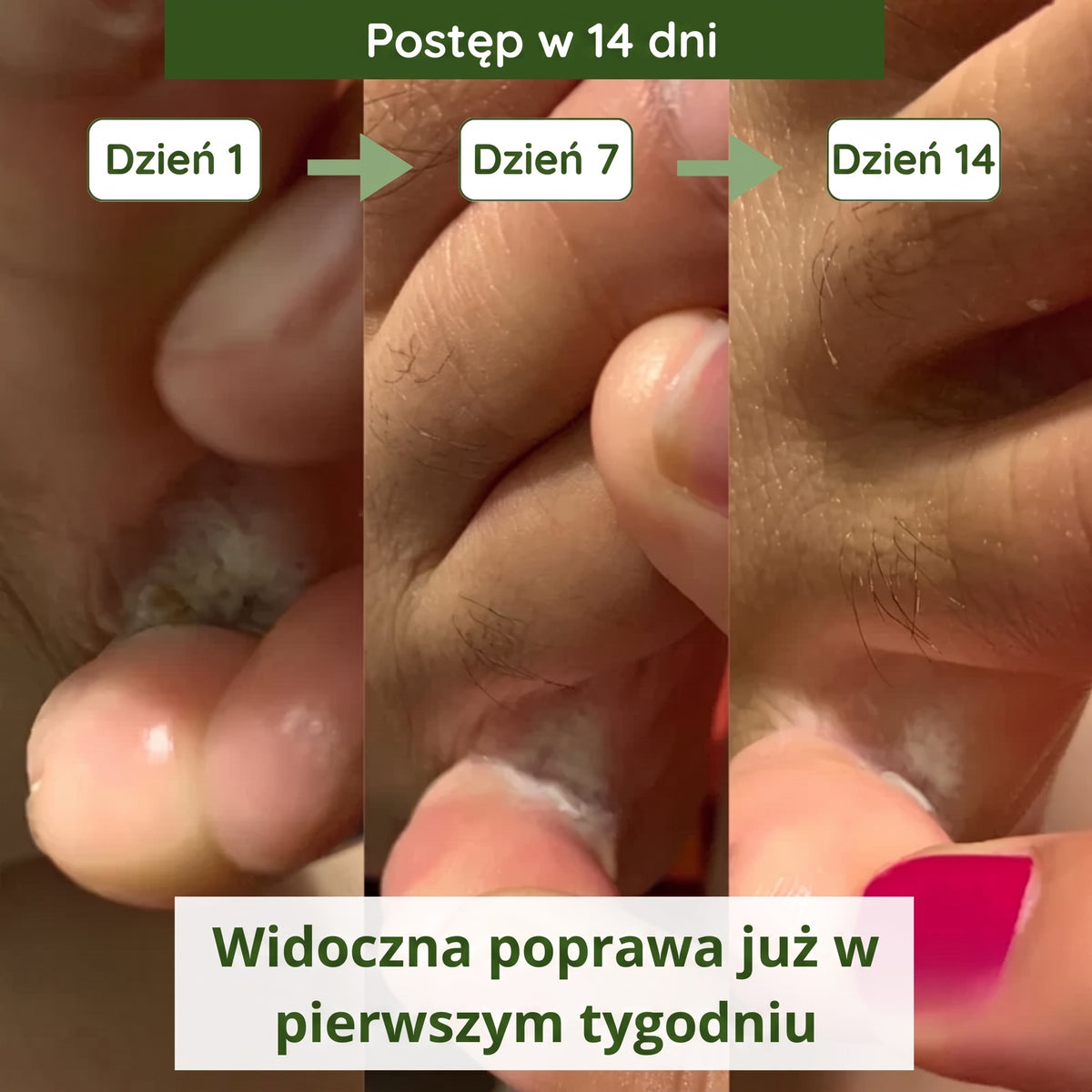 Mydło przeciwgrzybicze Winorandi